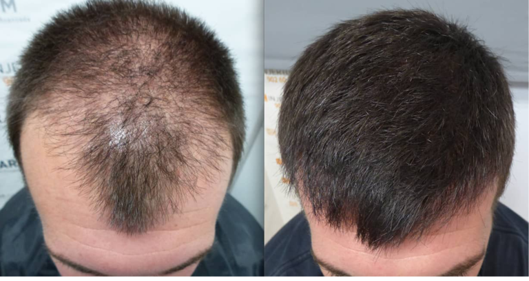 Terokai Cara Liputan Pemindahan Rambut Boleh Dicapai